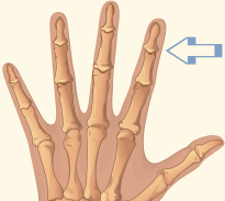 Distal Interphalangeal Joint